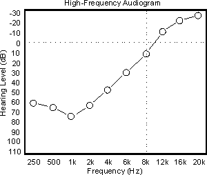 Audiogram of Neil's extreme reverse-slope loss