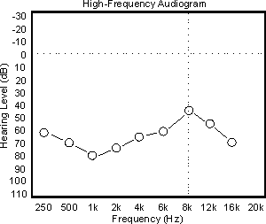 Audigram showing Neil's reverse-slope loss at age 59